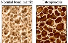 Osteoporosis Osteoporosis