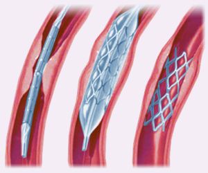 Balloon angioplasty and stents