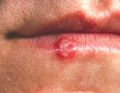 Cold sore caused by herpes simplex virus