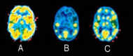 Brain PET scans