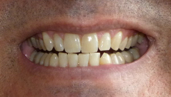 Teeth after whitening