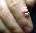 Warts are caused by viruses